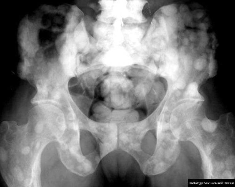 prostate metastases bone osteoblastic